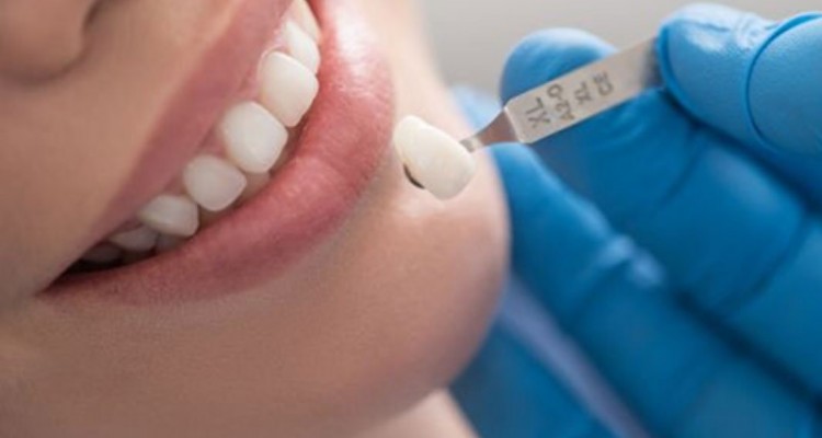 لمینت دندان برای چه افرادی مناسب است؟